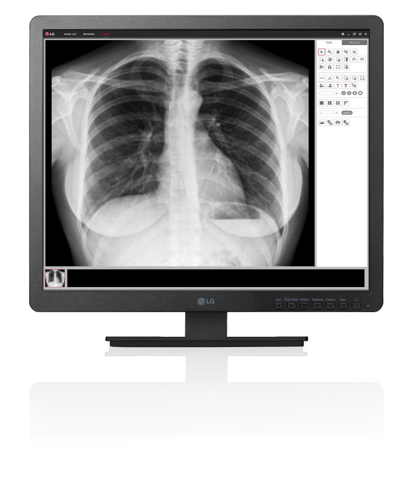 A front view of LG Clinical Review Monitor model 19HK312C displaying an X-ray of a person’s chest