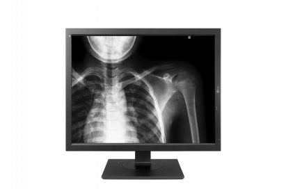 A front view of the LG Diagnostic Monitor model 21HK512D displaying an X-ray of a person’s upper body