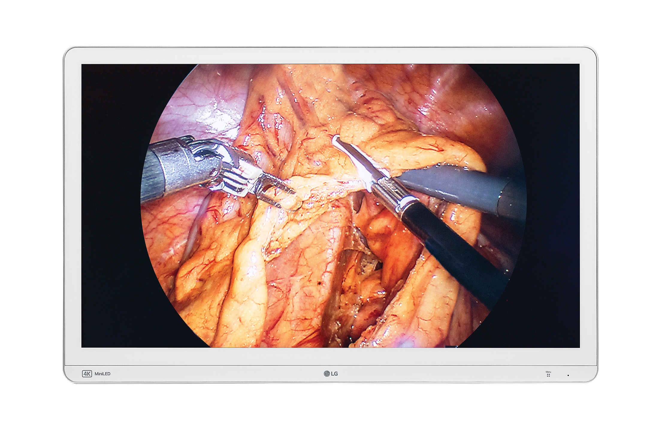 A photo of LG 32HR734S surgical monitor displaying a surgical scene